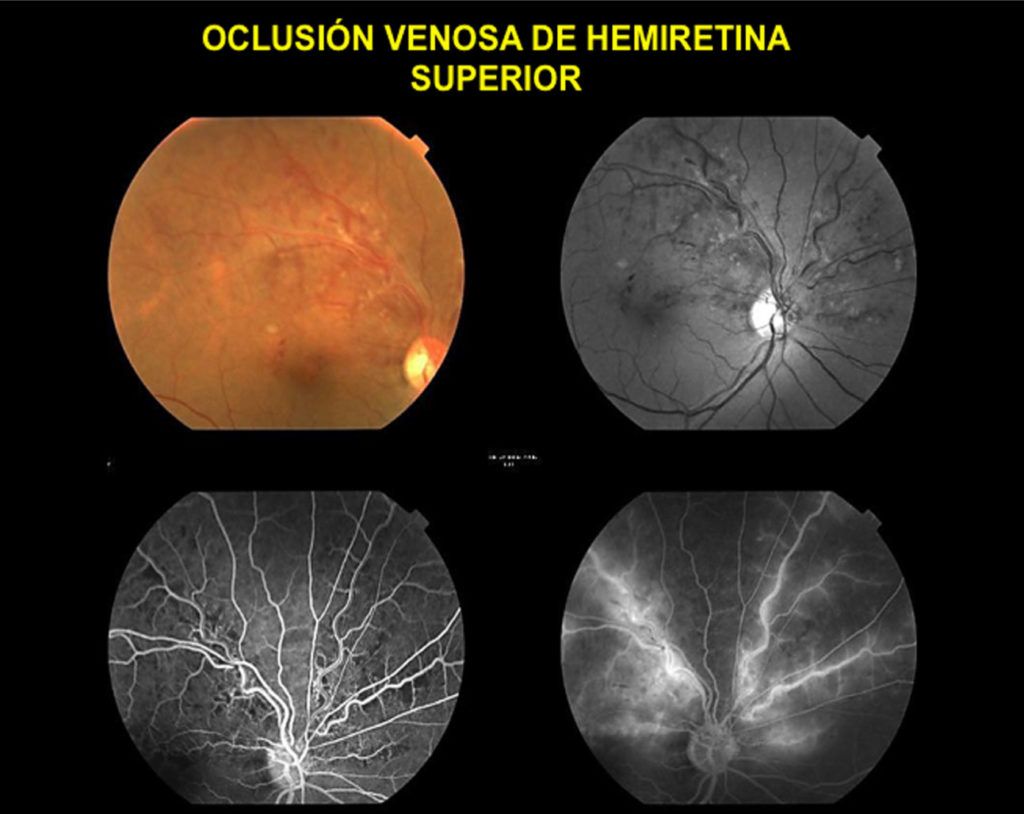 Oclusión De Vena De La Retina Somos Retina Y Mácula Consultores 7244