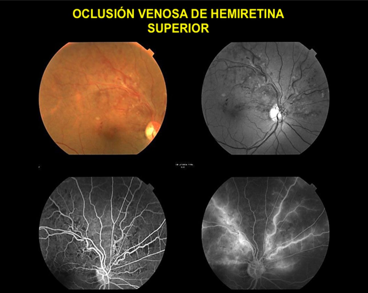 Oclusión De Vena De La Retina Somos Retina Y Mácula Consultores 6064