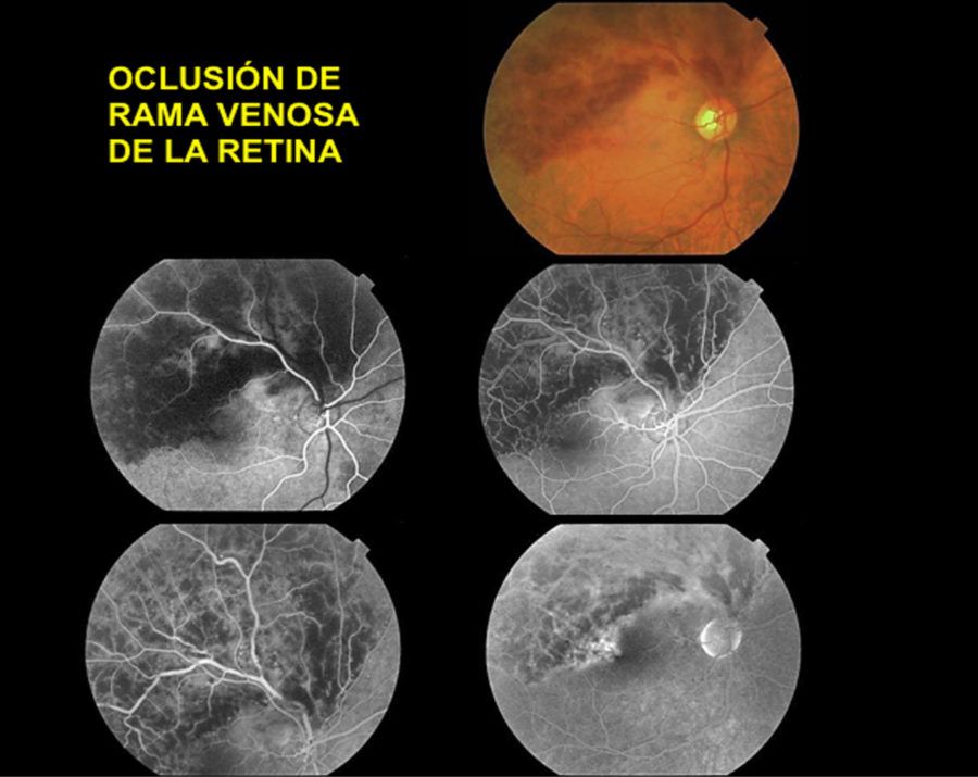 Oclusión De Vena De La Retina Somos Retina Y Mácula Consultores 6450