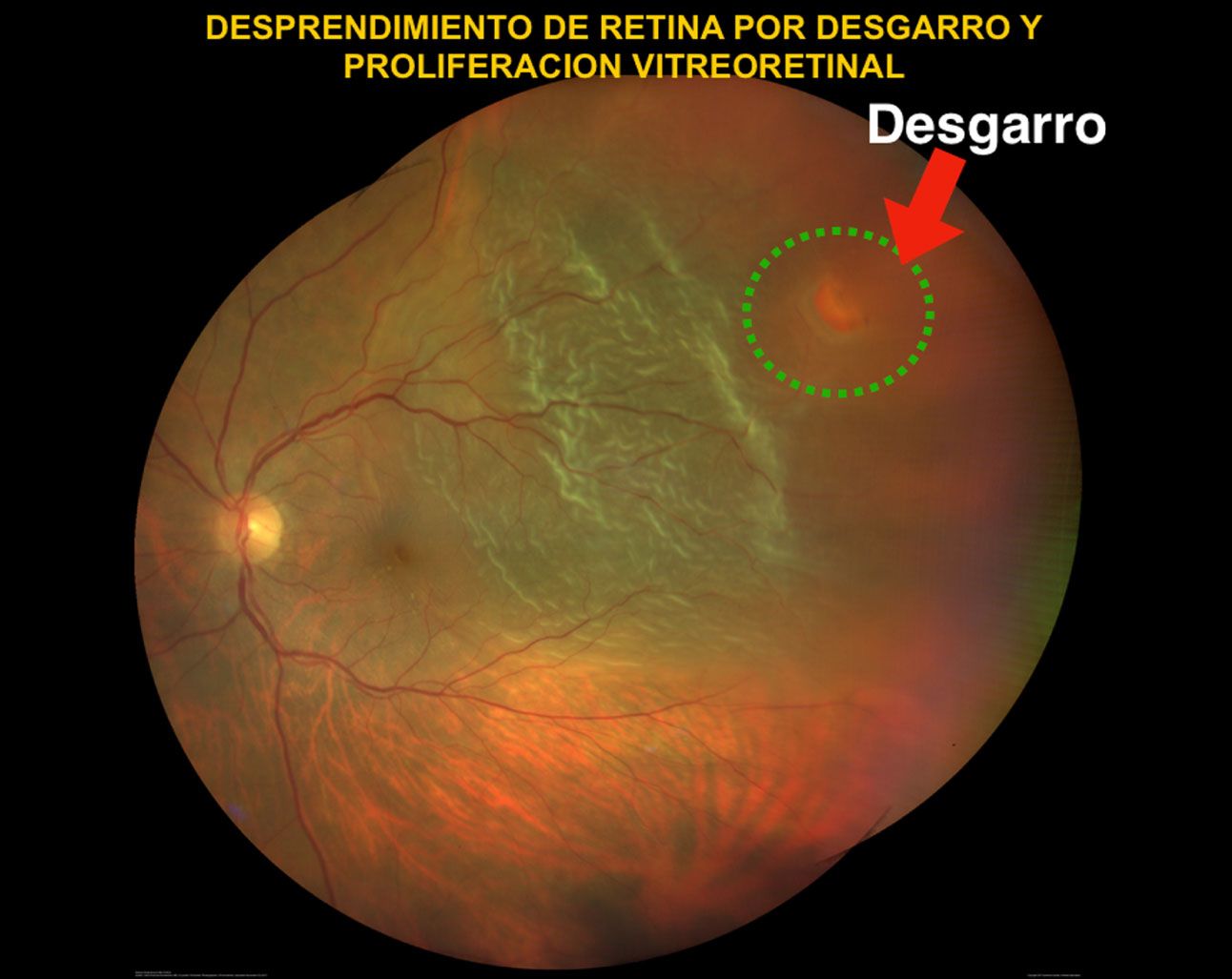 desprendimiento de retina como se ve