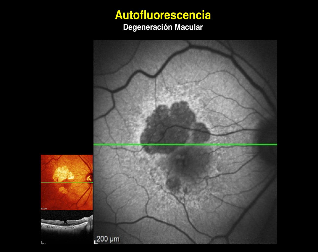 Qu Es La Autofluorescencia Somos Retina Y M Cula Consultores