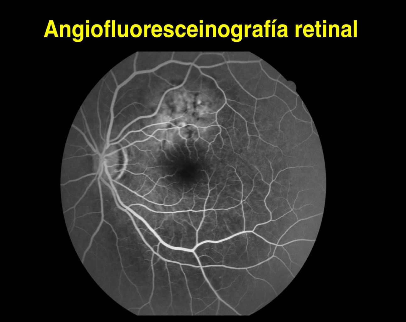 Angiograf A Retinal Somos Retina Y M Cula Consultores