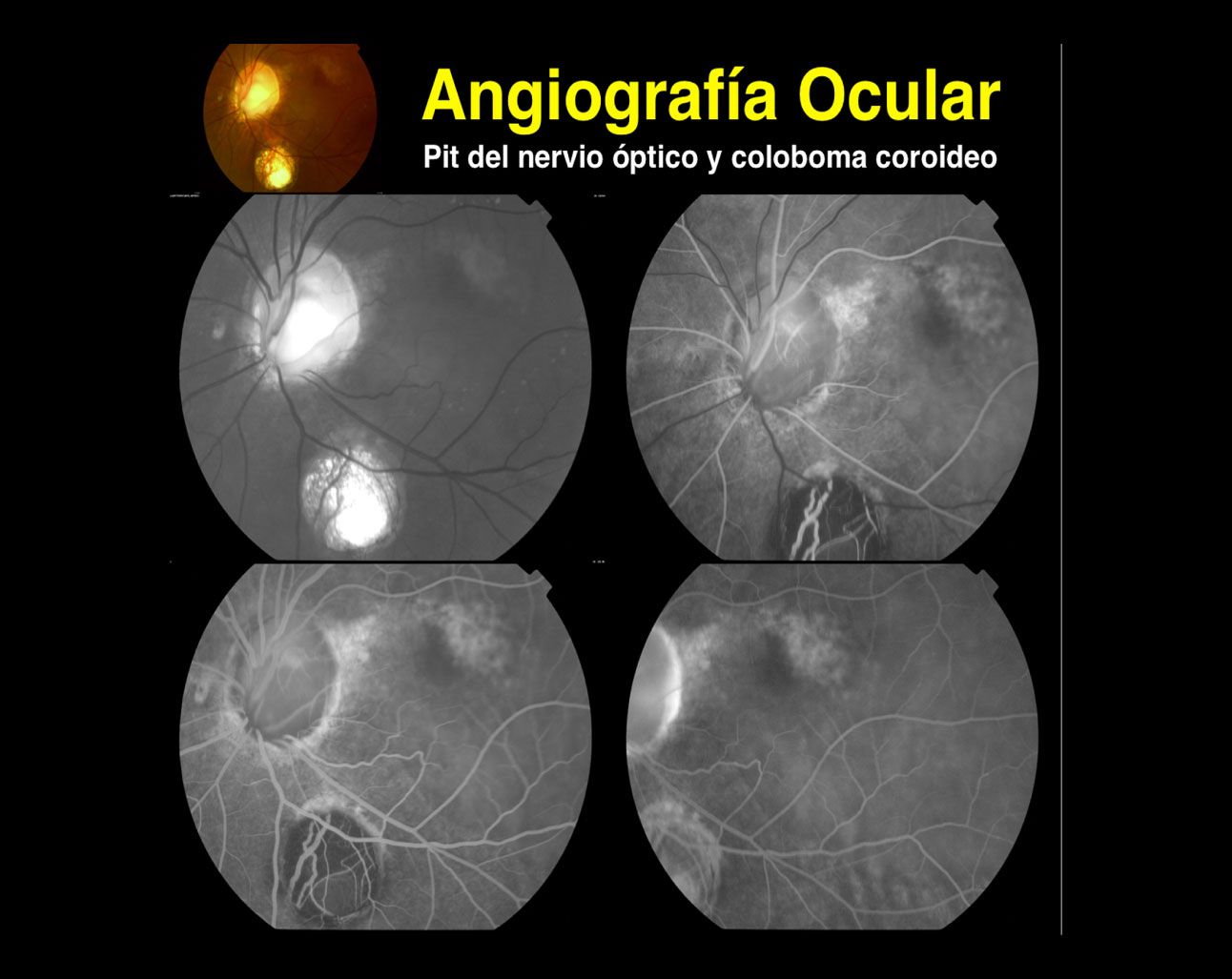 Angiografía Retinal Somos Retina Y Mácula Consultores 9136