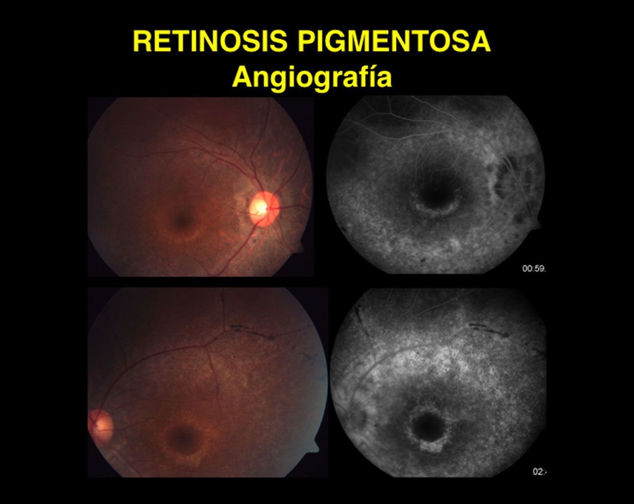 Angiografía Retinal Somos Retina Y Mácula Consultores 8452