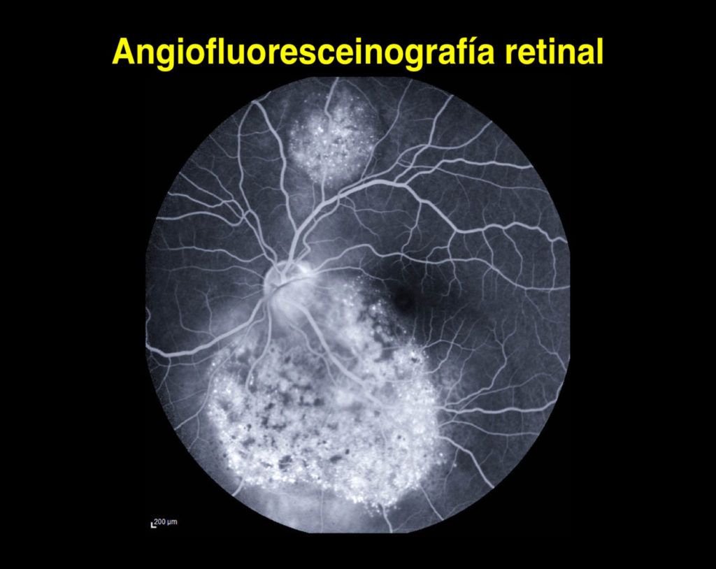 Angiografía Retinal Somos Retina y Mácula Consultores