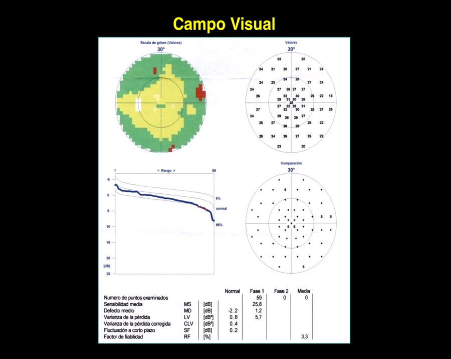 Campo Visual Somos Retina Y Mácula Consultores 9656