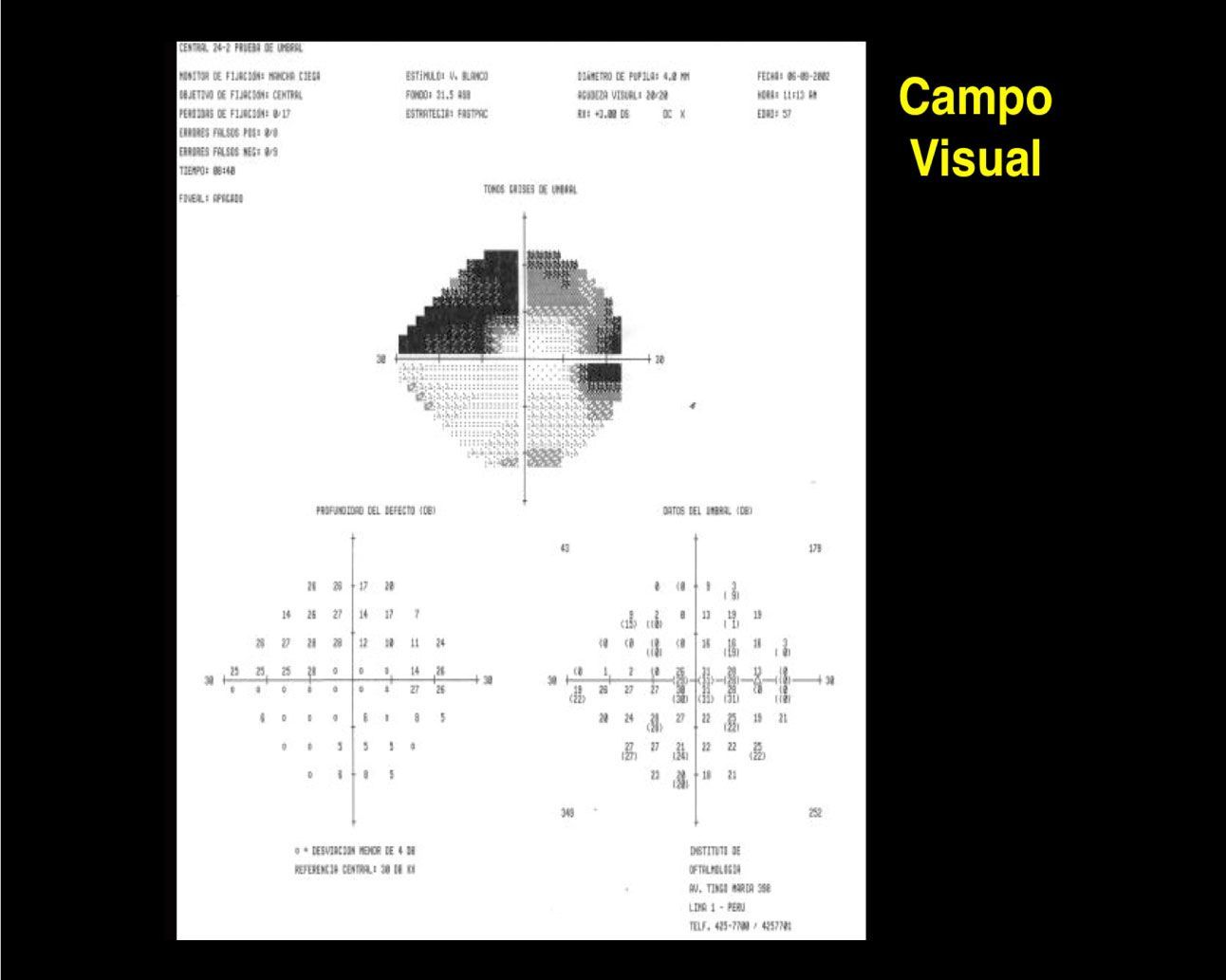 Campo Visual Somos Retina y Mácula Consultores