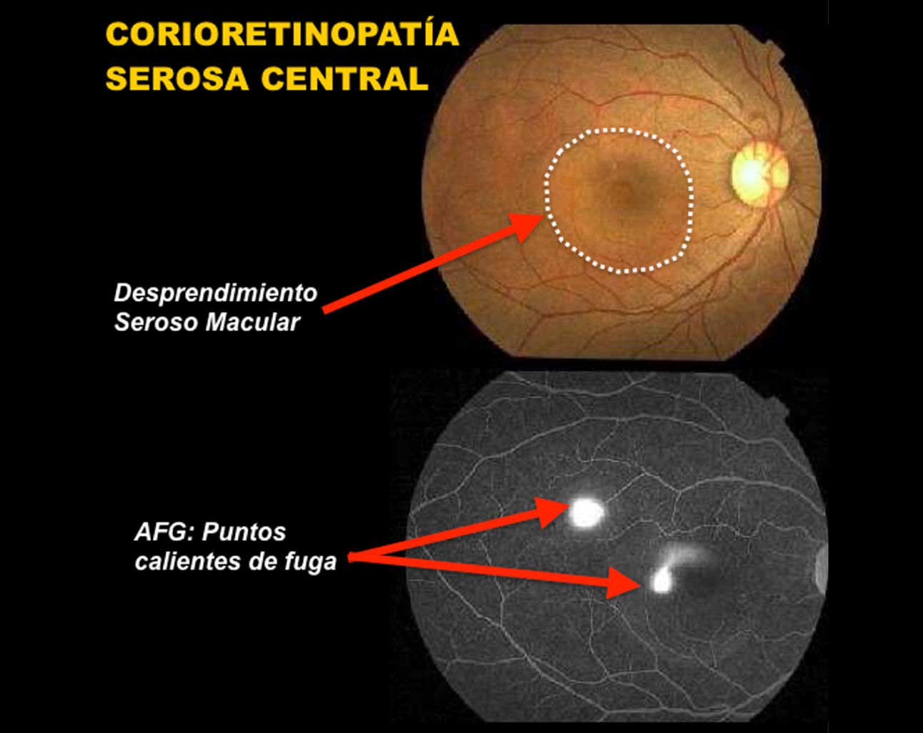 Coroidopatía Serosa Central Somos Retina Y Mácula Consultores 5201
