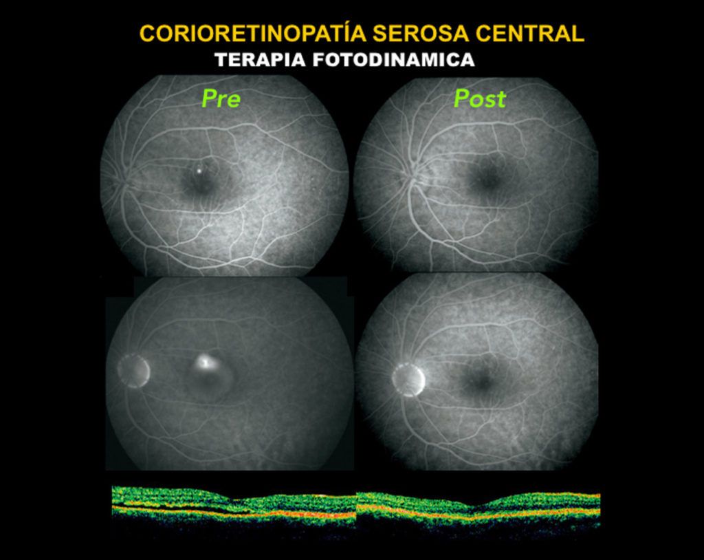 Coroidopatía Serosa Central Somos Retina y Mácula Consultores