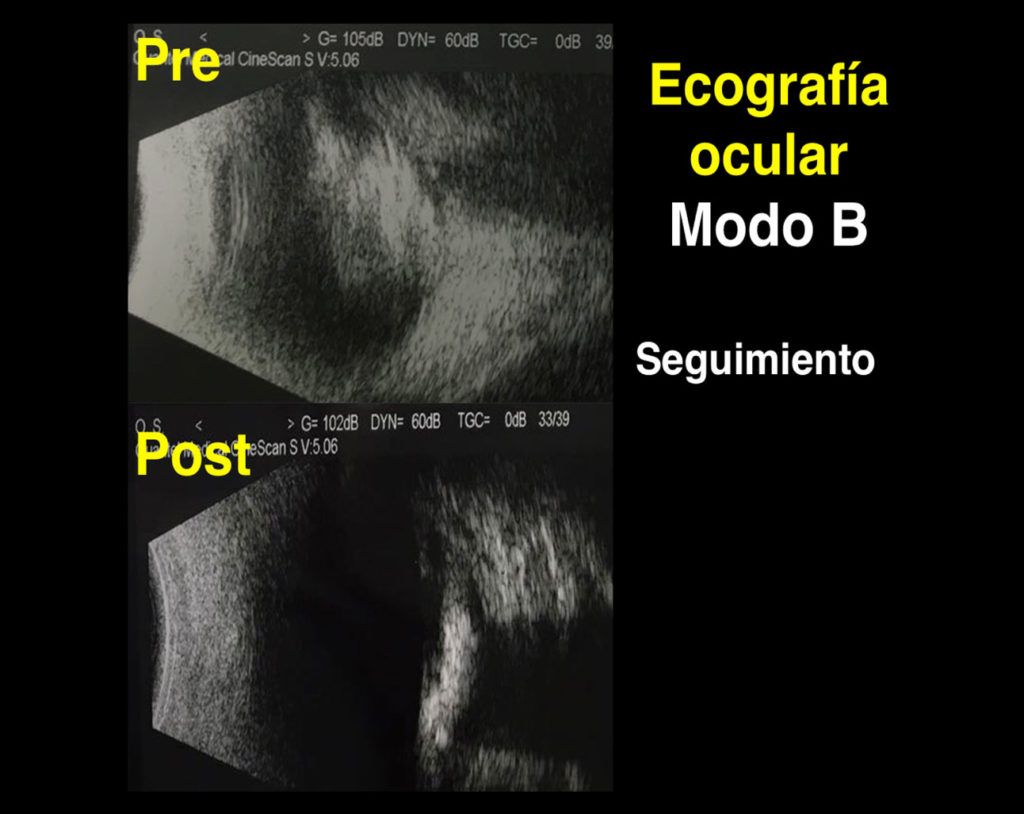 Ecografía Ocular Somos Retina Y Mácula Consultores 7605