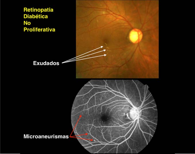 Retinopat A Diab Tica Somos Retina Y M Cula Consultores