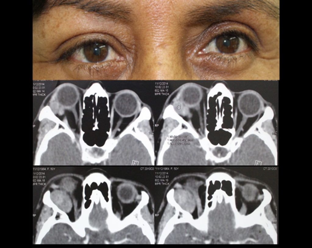 Tomografía Axial de la Órbita Somos Retina y Mácula Consultores