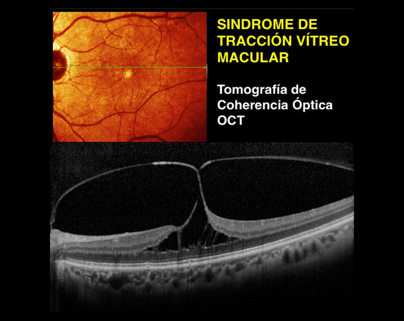 Tracción Vítreo Macular Somos Retina Y Mácula Consultores 4265