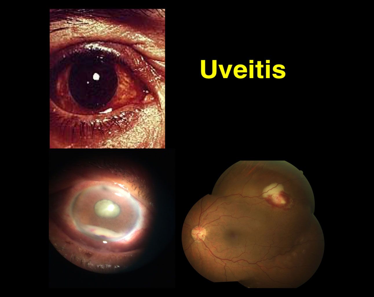 Uveítis:Inflamación De La Uvea | Somos Retina Y Mácula Consultores