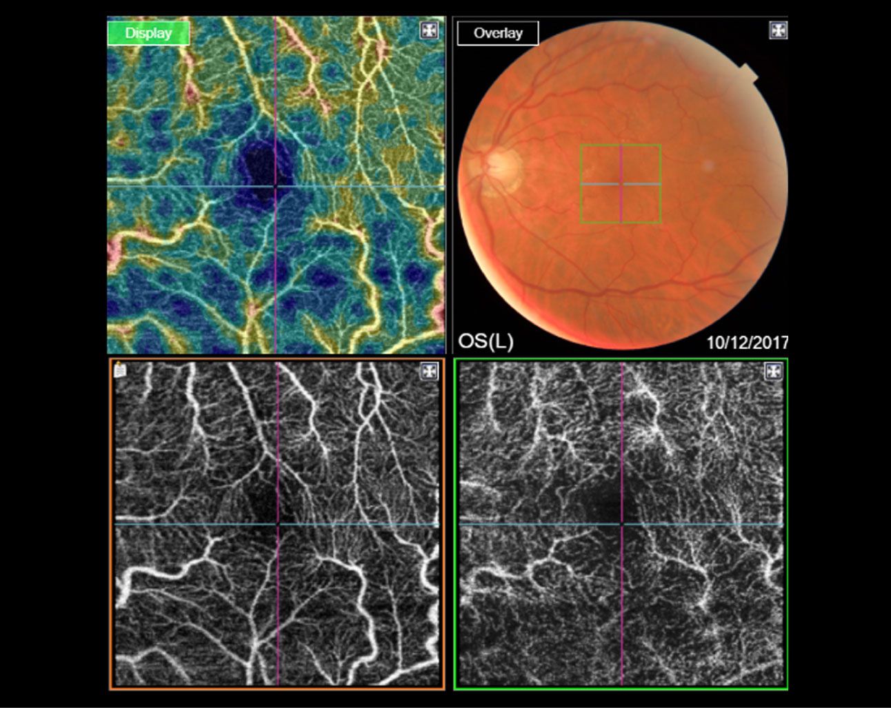 Angio Oct Somos Retina Y Mácula Consultores Retinólogos Expertos 8810