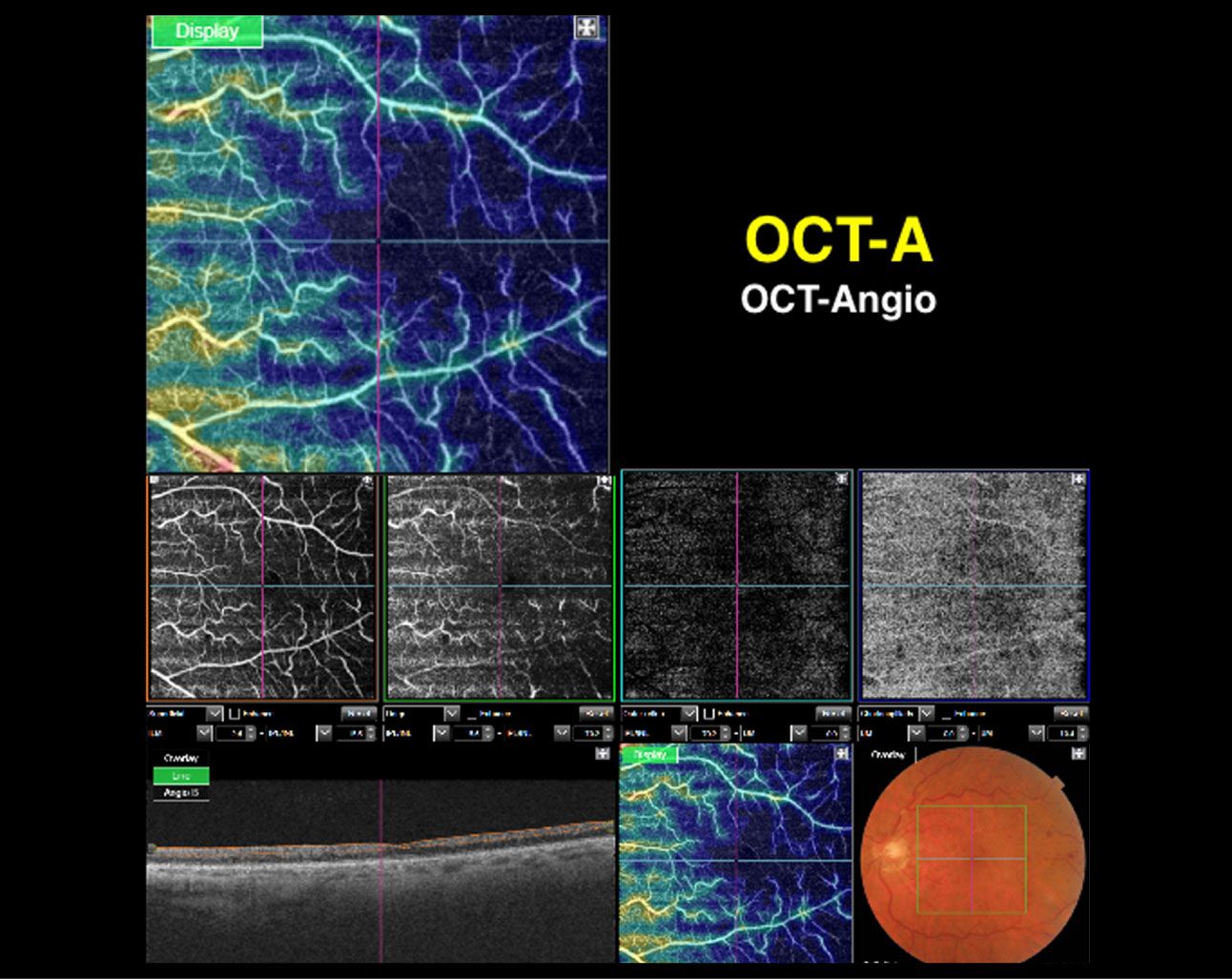 Angio Oct Somos Retina Y Mácula Consultores Retinólogos Expertos 8226