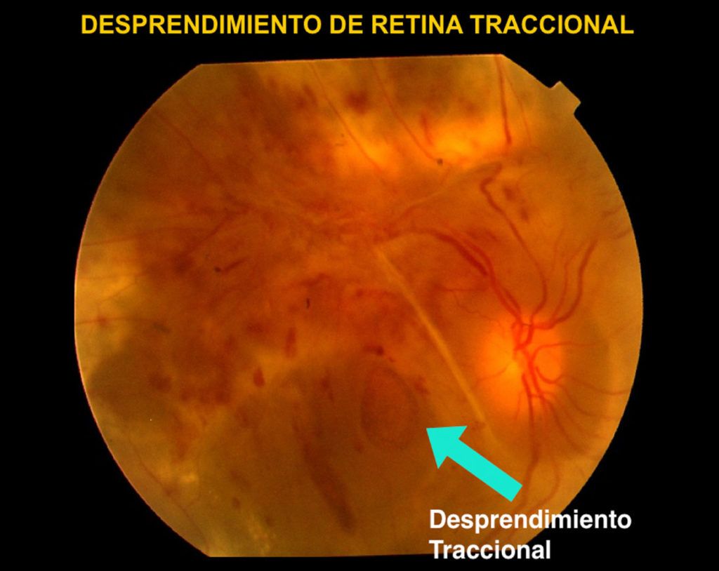 Desprendimiento de Retina | Somos Retina y Mácula Consultores