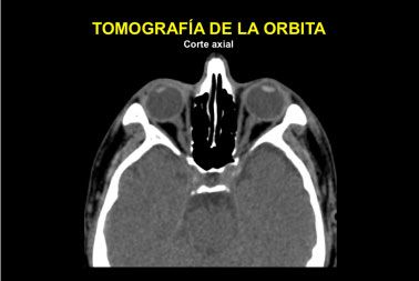 tomografia axial de la órbita
