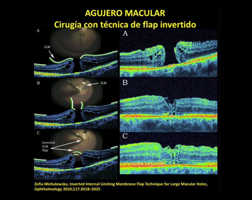 Agujero Macular Somos Retina Y Mácula Consultores 1357