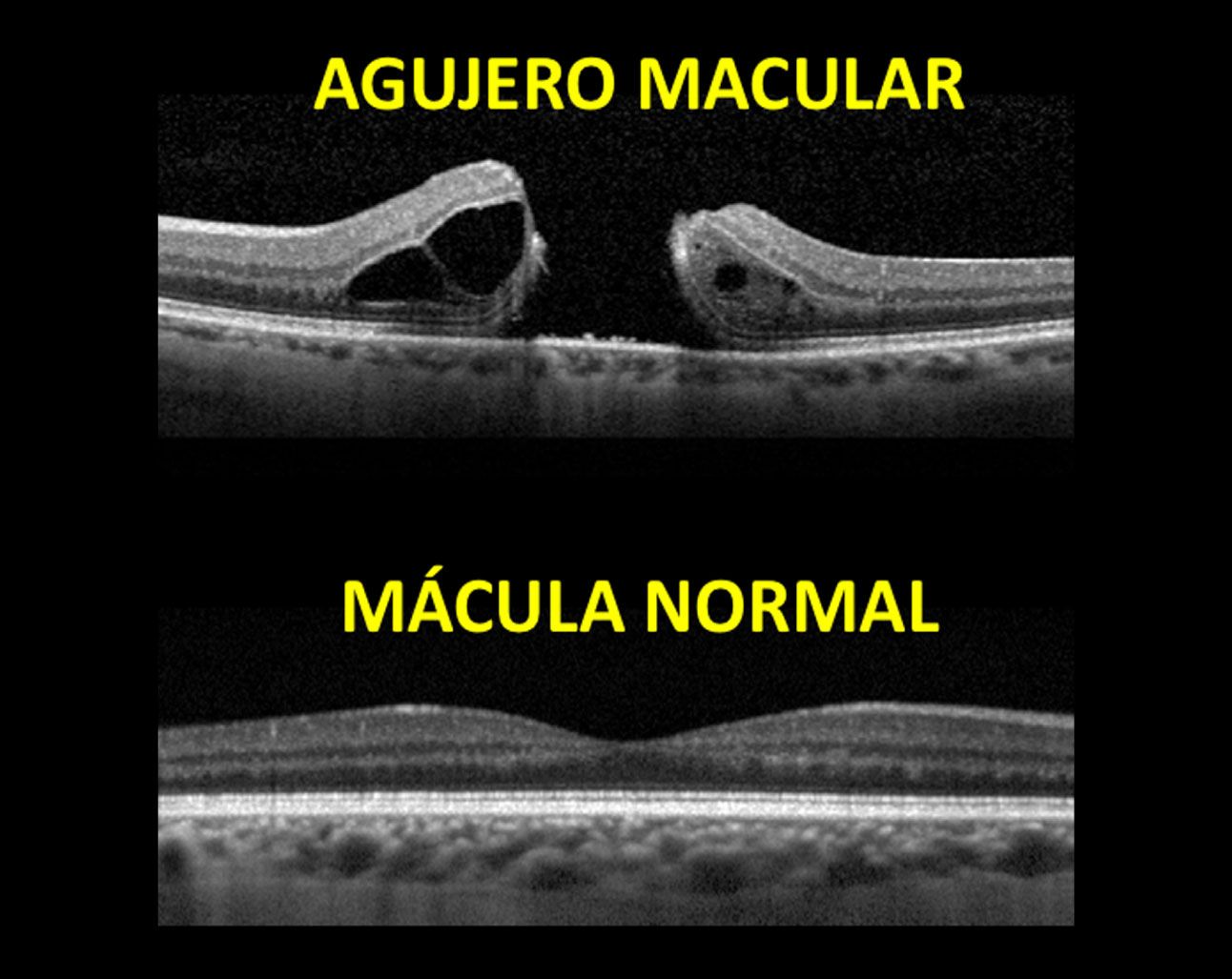 Agujero Macular Somos Retina Y Mácula Consultores 5938