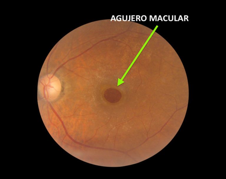 Agujero Macular Somos Retina Y Mácula Consultores 8032