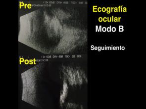 Ecografía Ocular | Somos Retina Y Mácula Consultores