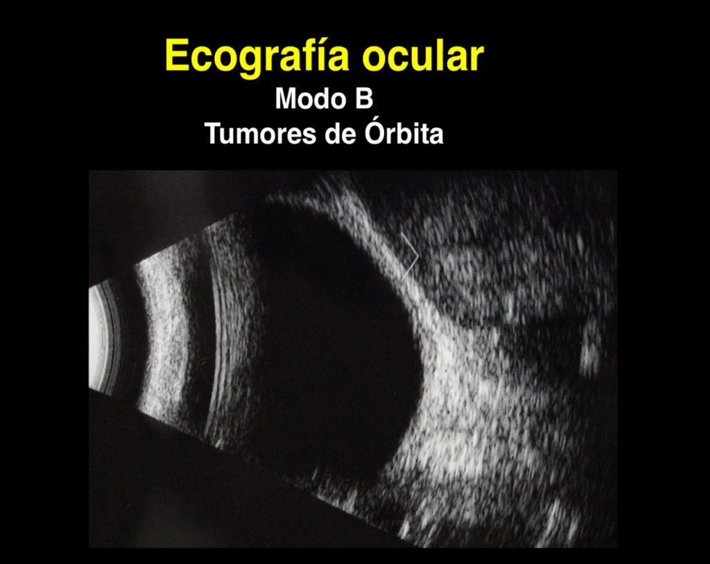 Ecografía Ocular Somos Retina Y Mácula Consultores 6692