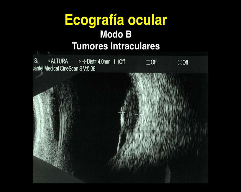 Ecografía Ocular | Somos Retina Y Mácula Consultores