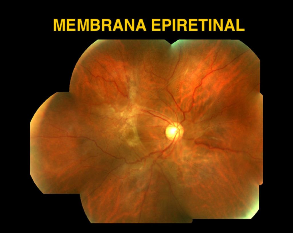 Membrana Epimacular Somos Retina Y Mácula Consultores 0773
