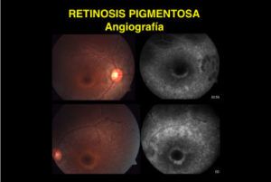 retinosis pigmentosa