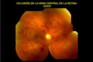 oclusión vena de retina
