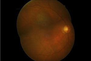 tumores de retina y coroides