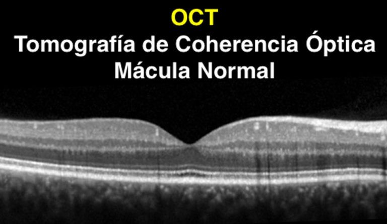 ¿qué Es La Mácula Somos Retina Y Mácula Consultoresemk 4051